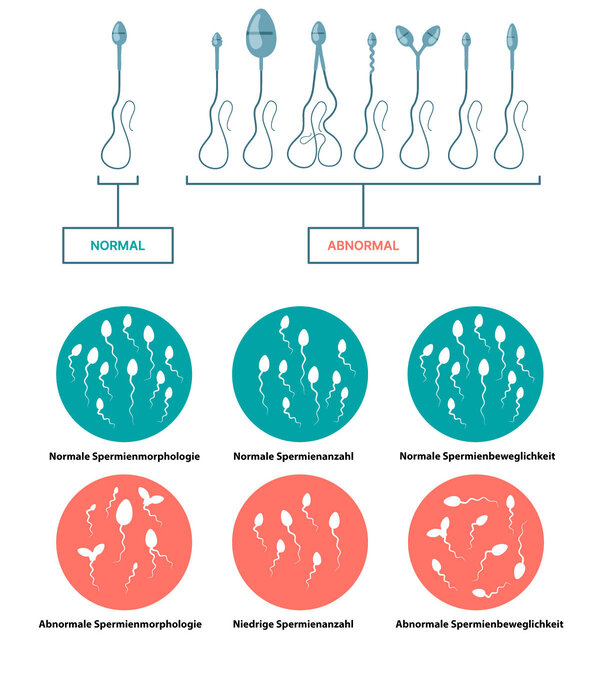 Graphische Darstellung von abnormalen und normalen Spermien